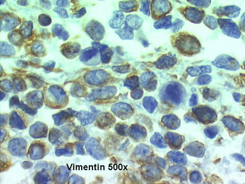 500x Vimentin positive staining