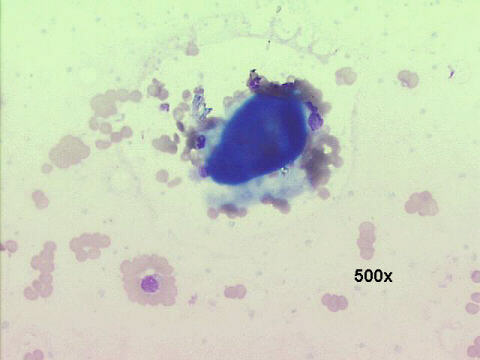 500x M-G-G staining, amyloid globule
