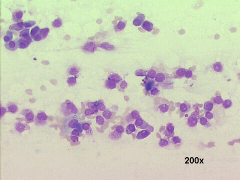 200x M-G-G staining, dispersed plasmacytoid cells pattern