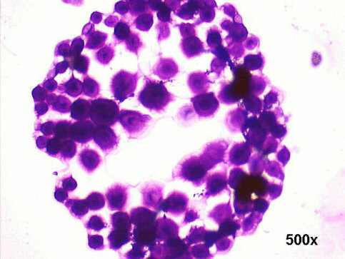 500x M-G-G staining, large ball of organisms