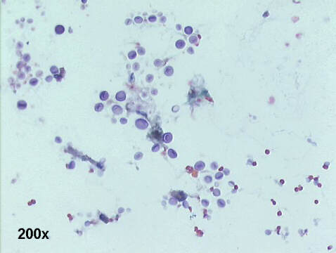 200x Papanicolaou staining, notice the unstained clear halos around the organisms