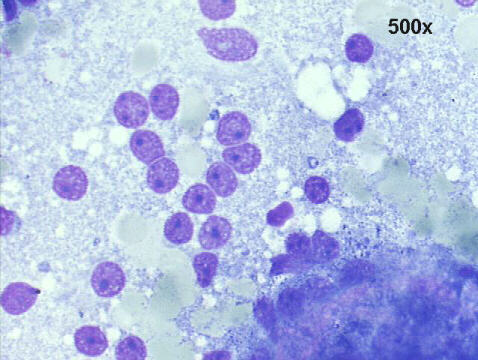 Dispersed naked nuclei with prominent nucleoli. 500x M-G-G staining