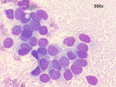 500x M-G-G staining, loose cluster of ductal cells, with some nuclear moulding