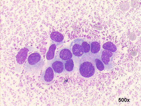 Gynecomastia, false positive cytology, 500x M-G-G staining, loose cluster with anisonucleosis