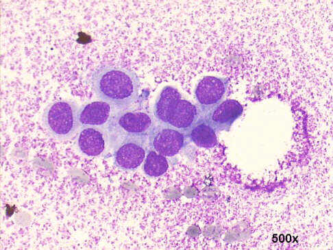 G, ynecomastia, false positive cytology500x M-G-G staining, hyperchromatic nuclei