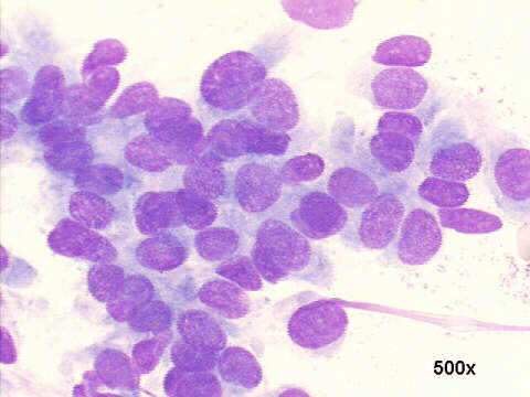 Gynecomastia, false positive cytology, 500x M-G-G staining, loose cluster with nuclear crowding, slight anisonucleosis