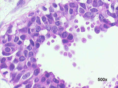 500x H&E staining, in the high power view, the multilayered ductal epithelium has some clearly atypical cells