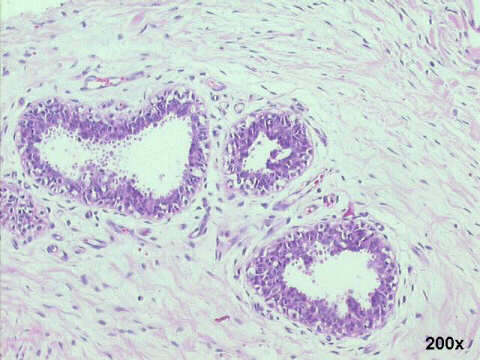 200x H&E staining, typical aspect of gynecomastia, proliferating ducts and loose stroma