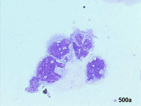 500x M-G-G staining, lymphoblasts with cytospin artifacts (pseudo-flower cells), rim of cytoplasm with lipid vacuoles