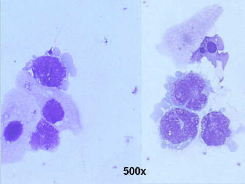 500x M-G-G staining, lymphoblast with cytospin artifacts (pseudo-flower cells)