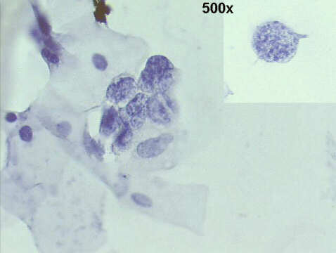 500x Papanicolaou staining, normal squamous cells, and a loose aggregate of abnormal lymphoid cells