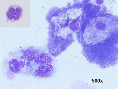 500x M-G-G staining, lymphoblasts with cytospin artifacts (pseudo-flower cells), many bacteria and clue cells