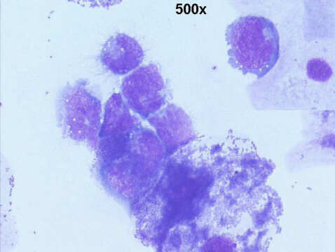 500x M-G-G staining, clue cells with many bacteria, lymphoblasts with cytospin artifacts (pseudo-flower cells)