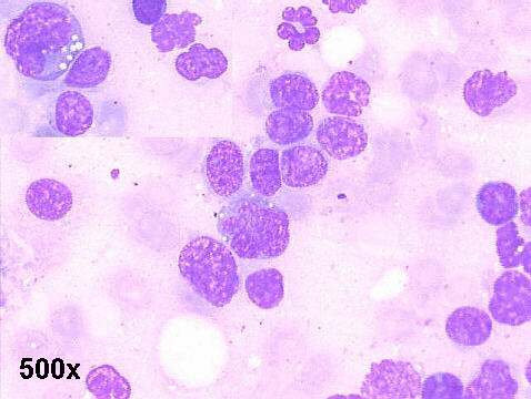 500x M-G-G staining imprint lung biopsy