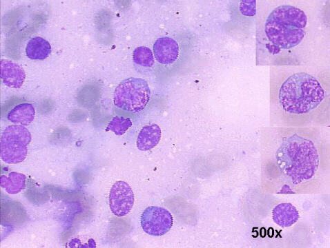 500x M-G-G staining imprint lung biopsy