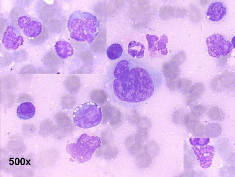 500x M-G-G staining imprint lung biopsy