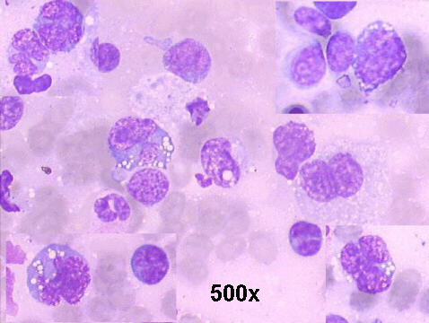 500x M-G-G staining imprint lung biopsy