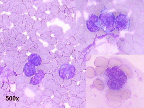 500x M-G-G pleural effusion