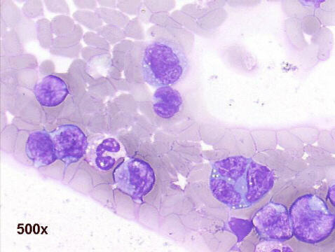 500x M-G-G staining pleural effusion