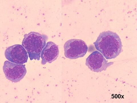 500x M-G-G staining, several lymphoblasts