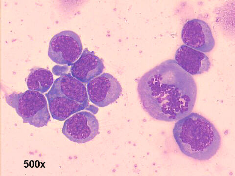 500x M-G-G staining, blast cells, one mitotic figure