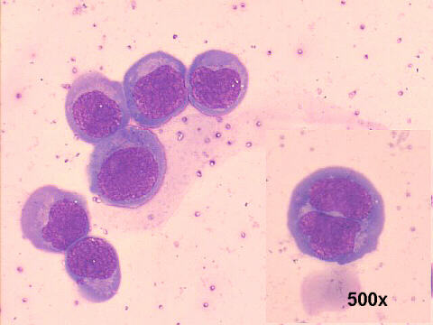 500x M-G-G, blast cells, one large binucleated cell