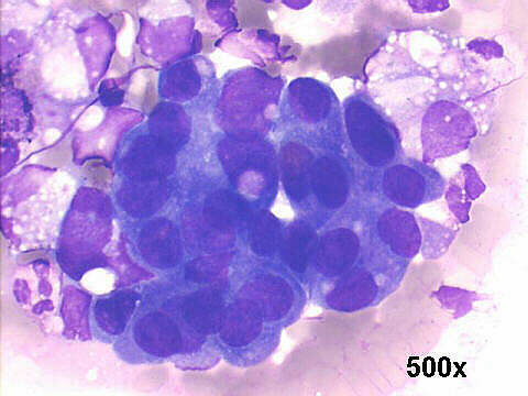 Muco-papillary adenocarcinoma, 500x M-G-G staining