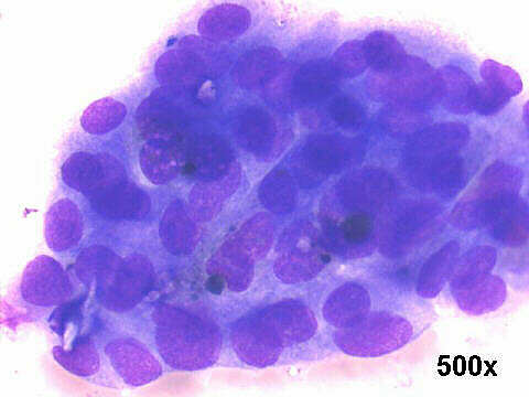 Muco-papillary adenocarcinoma, 500x M-G-G staining
