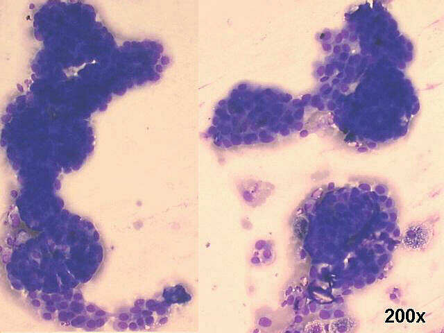 Muco-papillary adenocarcinoma, 200x M-G-G staining