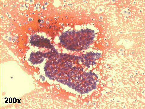 FNA lung: 200x, Pap staining: muco-papillary adenocarcinoma