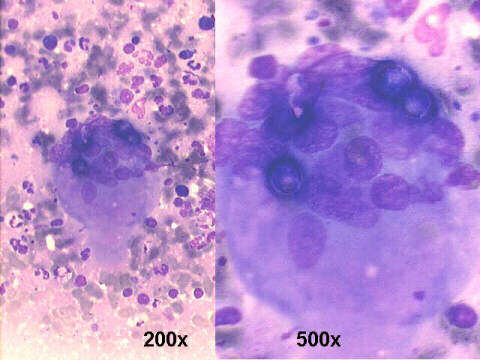 FNA cervical node, 200x, 500x M-G-G staining