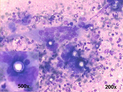 FNA cervical node, 200x, 500x M-G-G staining
