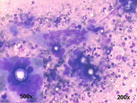 S.A. Blastomycosis, Paracoccidioides brasiliensis, 200x, 500x M-G-G staining