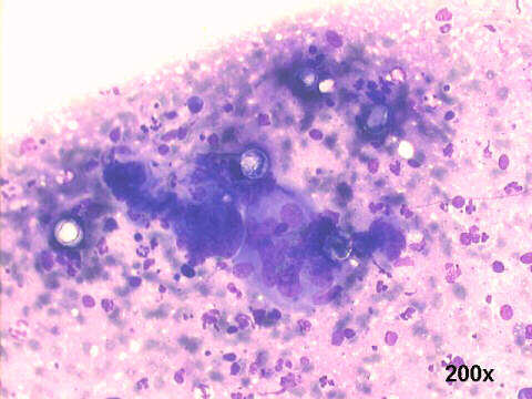 S.A. Blastomycosis, Paracoccidioides brasiliensis, 200x M-G-G staining