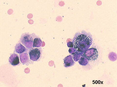 FNA eye cytology: 500x oil M-G-G staining, pigmented malignant cells