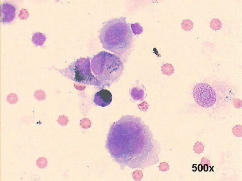 Cytology choroidal melanoma, 500x M-G-G staining, pigmented malignant cells