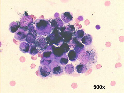 choroidal melanoma, 500x M-G-G staining, pigmented malignant cells