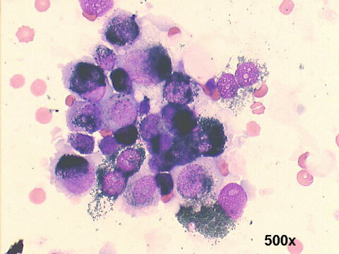 choroidal melanoma, 500x M-G-G staining, pigmented malignant cells