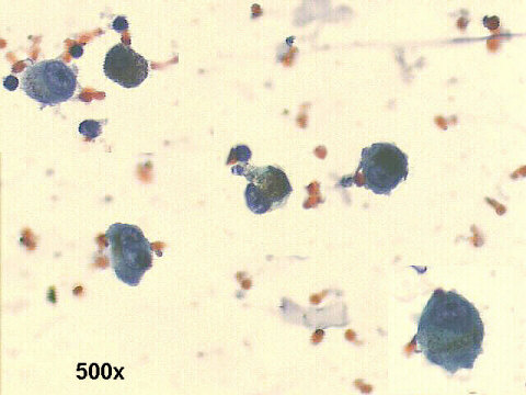 choroidal melanoma, 500x Pap staining, pigmented malignant cells