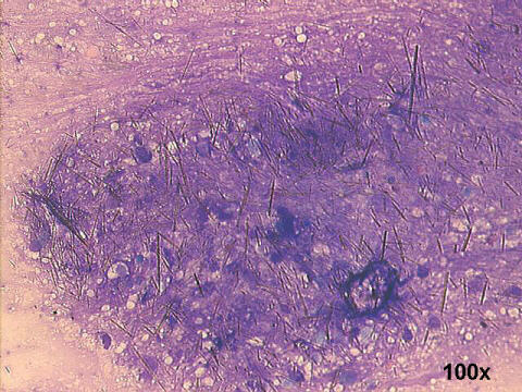 gout arthritis.
100x M-G-G staining, needle crystals