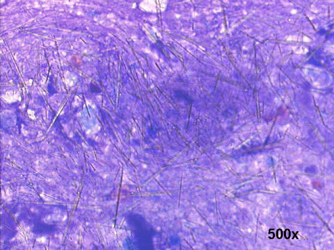 gout arthritis. 500x M-G-G staining, needle crystals