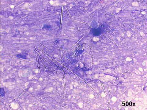 gout arthritis. 500x M-G-G staining, needle crystals