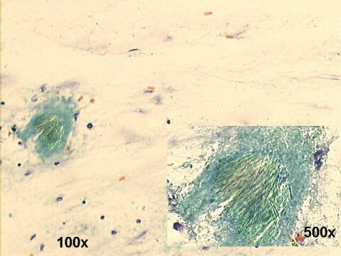 gout arthritis. 100x and 500x Papanicolaou staining, needle crystals