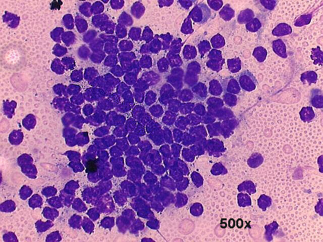 Warthins tumor (adenolymphoma), 500x M-G-G staining, detail view of agregate of lymphocytes