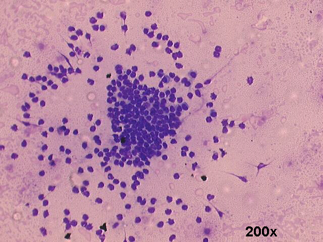 Warthins tumor (adenolymphoma), 200x M-G-G staining, agregate of lymphocytes
