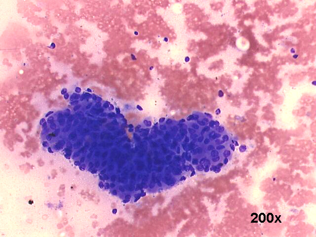 Warthins tumor (adenolymphoma), 200x M-G-G staining, sheet of oncocytic cells, scattered lymphocytes
