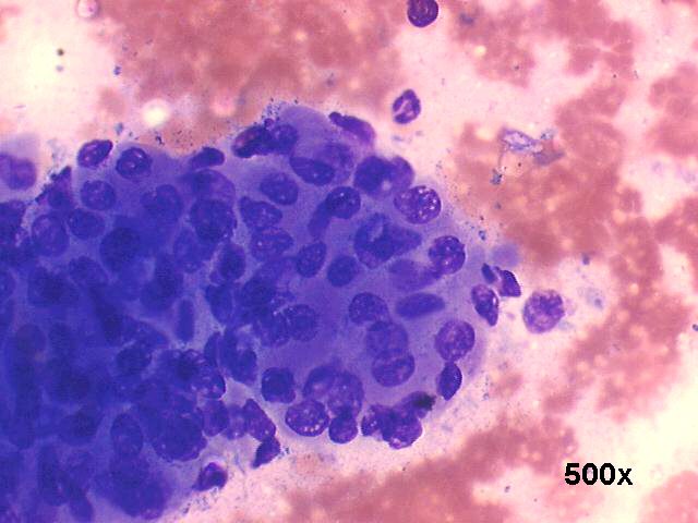 Warthins tumor (adenolymphoma), 500x M-G-G staining, sheet of oncocytic cells, detail view