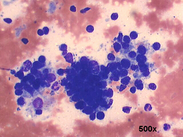 Warthins tumor (adenolymphoma), 500x M-G-G staining, sheet of oncocytic cells, scattered lymphocytes, detail view