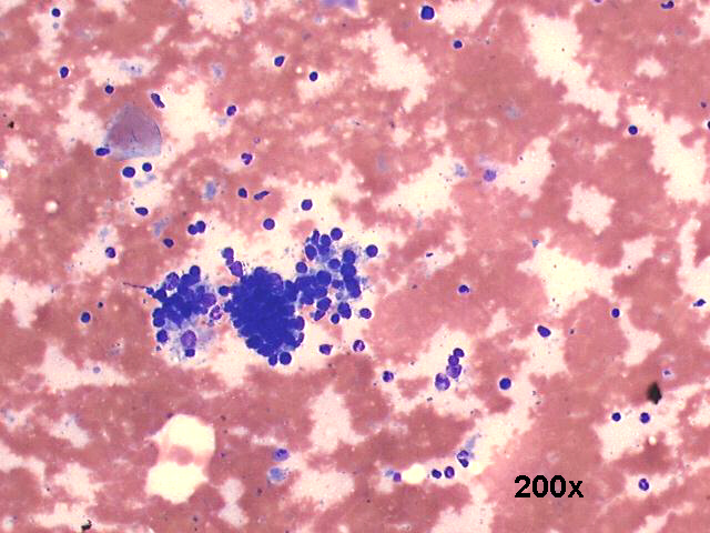 Warthins tumor (adenolymphoma), 200x M-G-G staining, sheet of oncocytic cells, scattered lymphocytes, some background debris