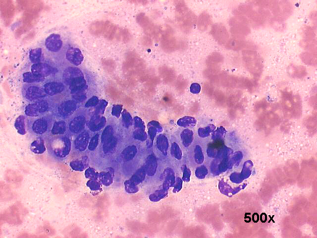 Warthins tumor (adenolymphoma), 500x M-G-G staining, sheet of oncocytic cells, scattered lymphocytes